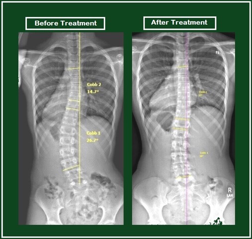 Scoliosis 1 IMG 0102